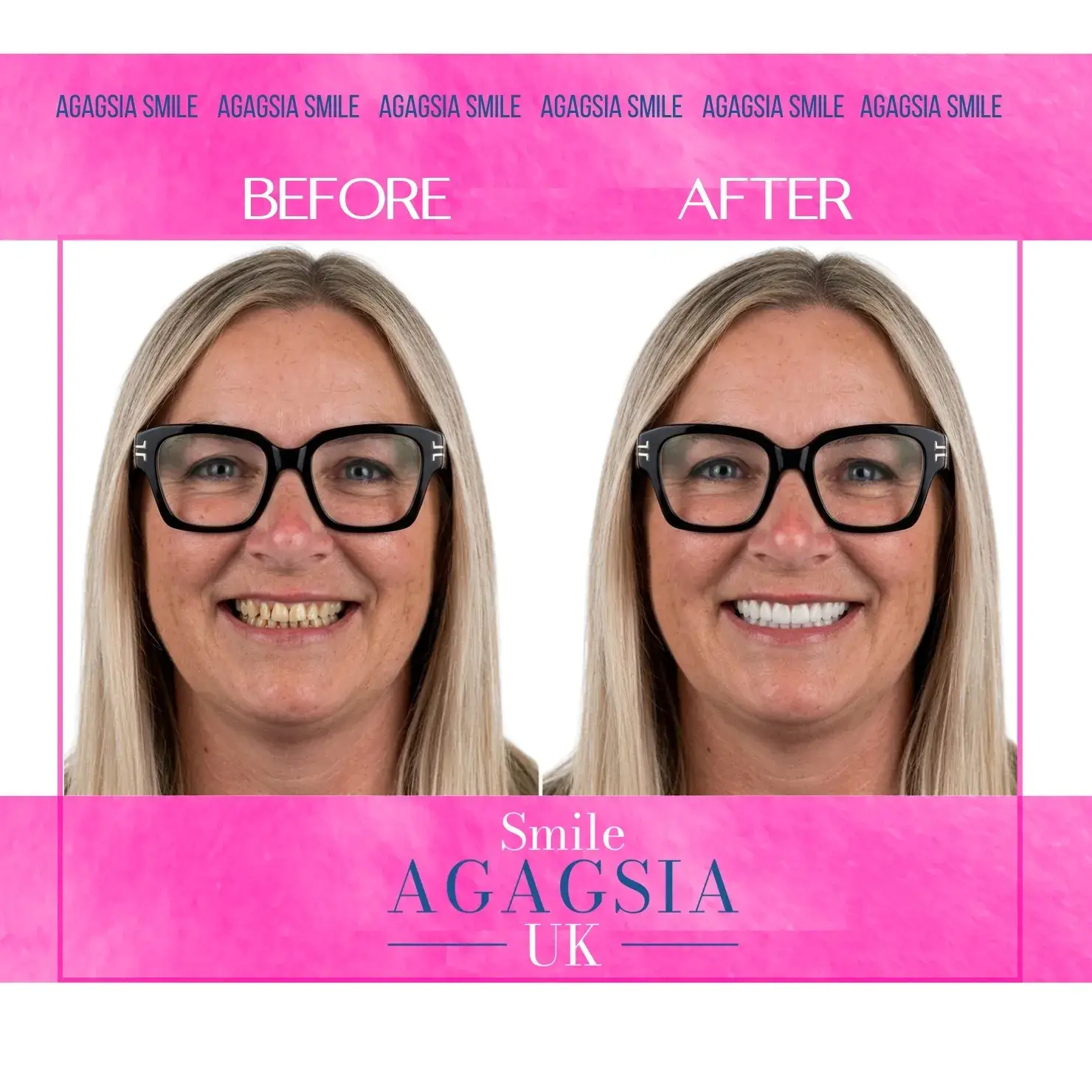 Before / After — Hollywood Smile