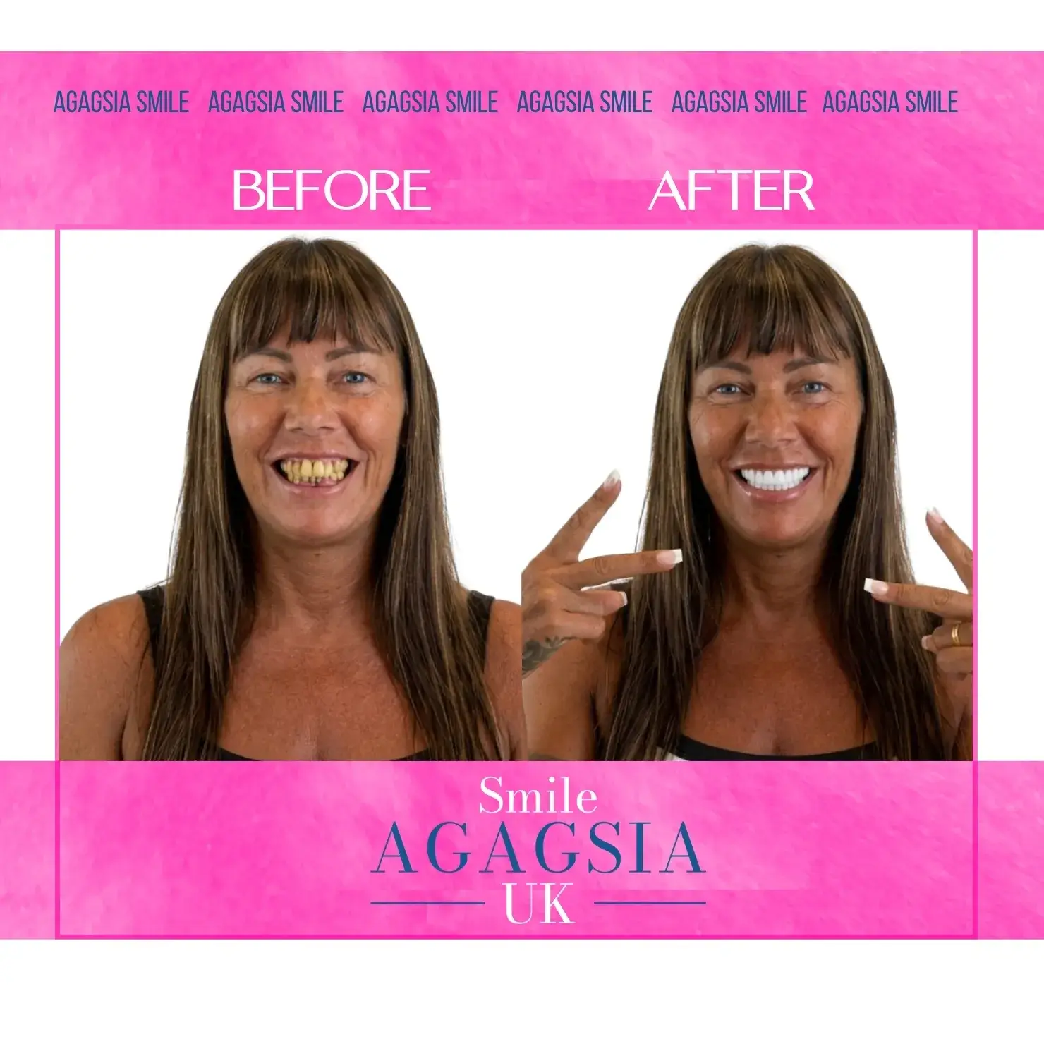 Before / After — Dental Implants & Crowns