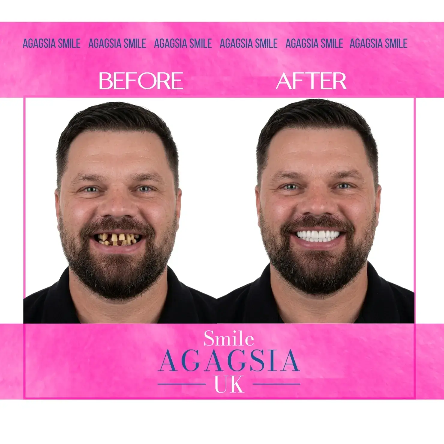Before / After — All-on-4 Dental Implants