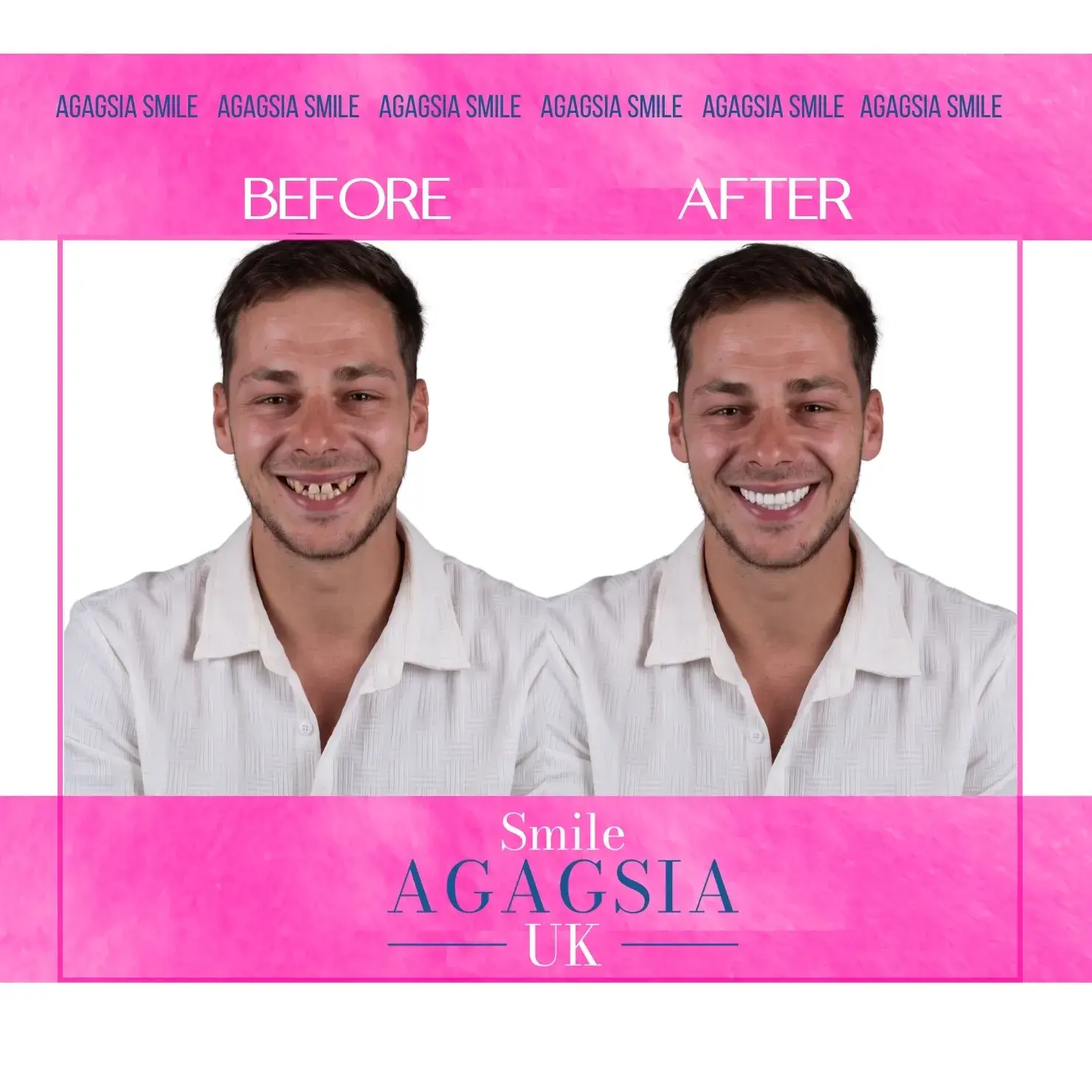 Before / After — Zirconia Veneers