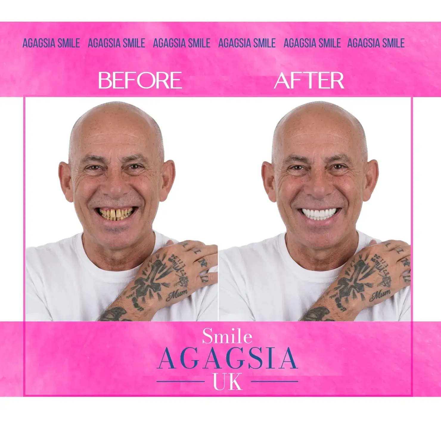 Before / After — Zirconia Crowns