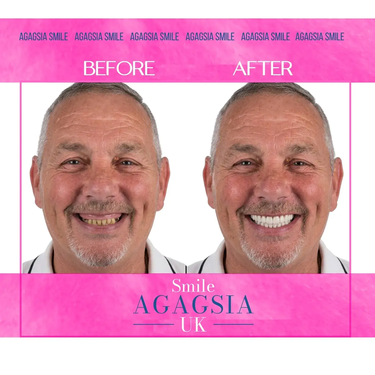 Before / After — Full Mouth Restoration