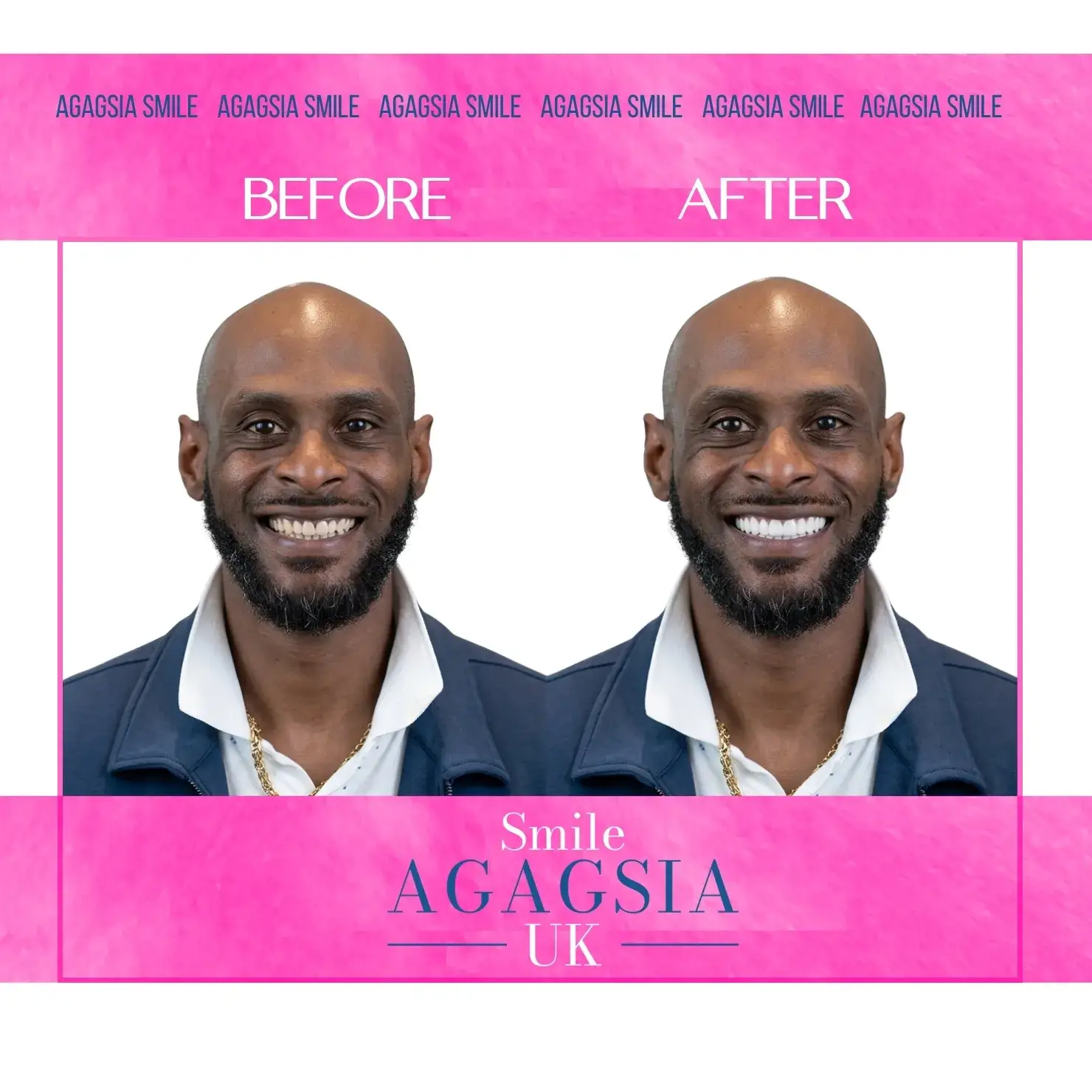 Before / After — Hollywood Smile