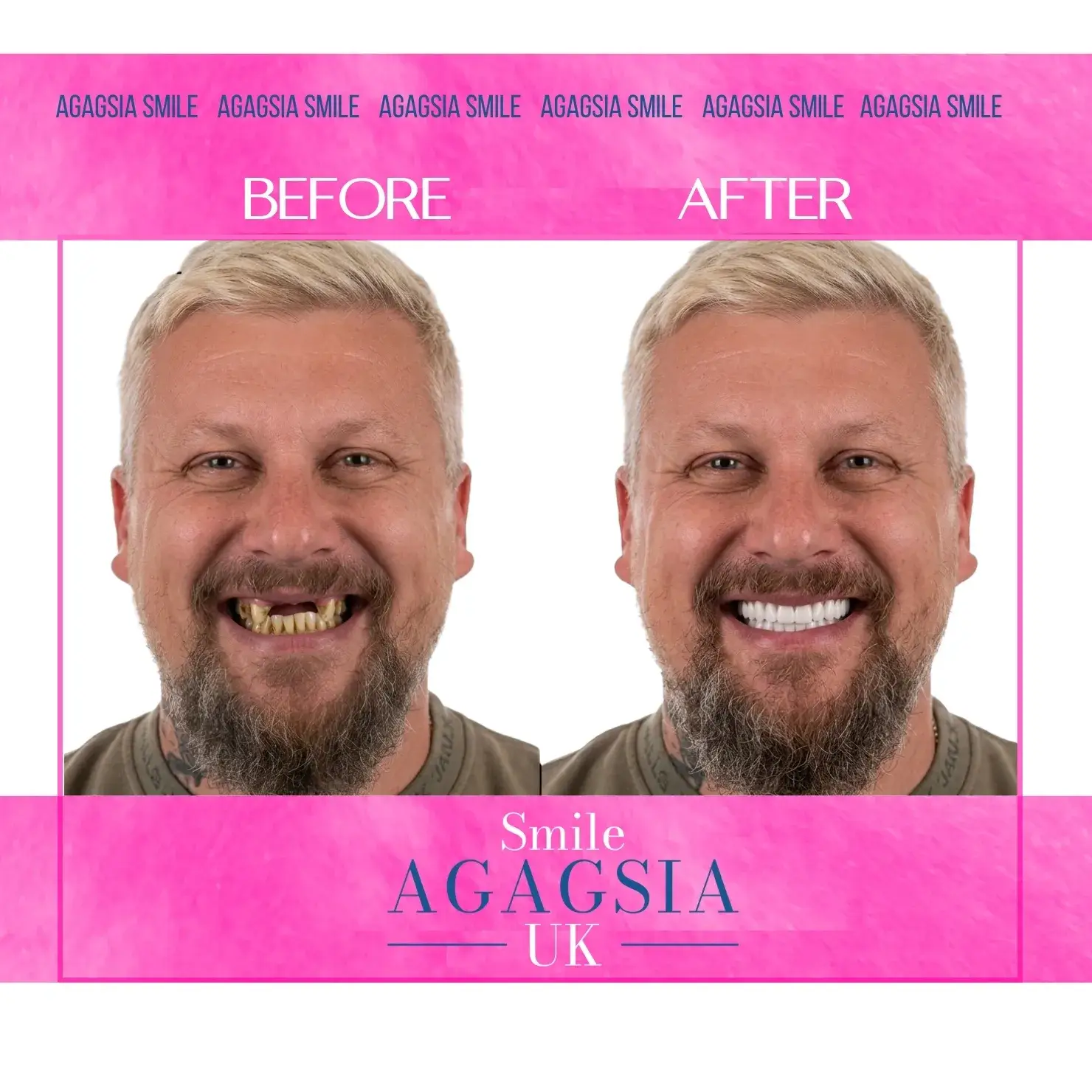 Before / After — Zirconia Crowns