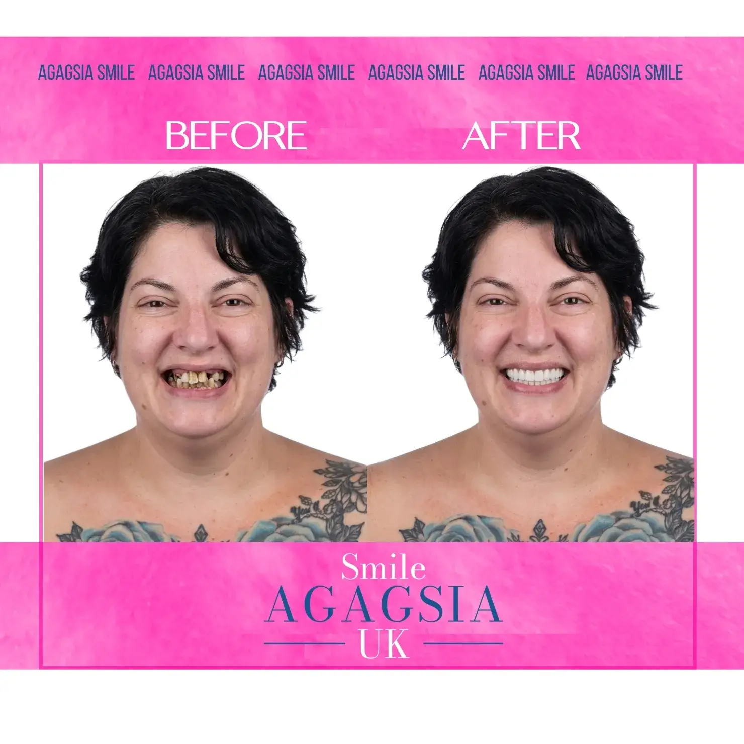 Before / After — All-on-6 Dental Implants