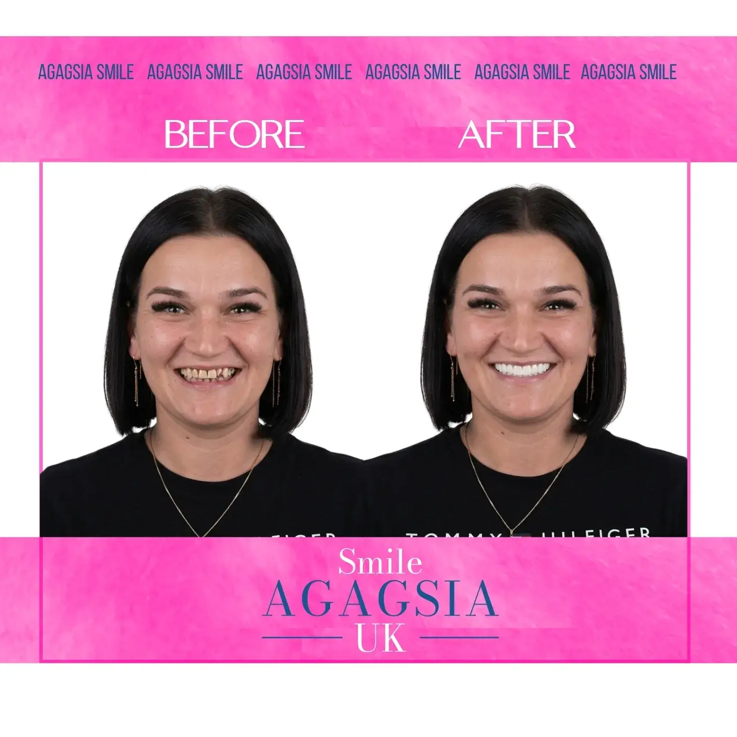 Before / After — E-max Veneers