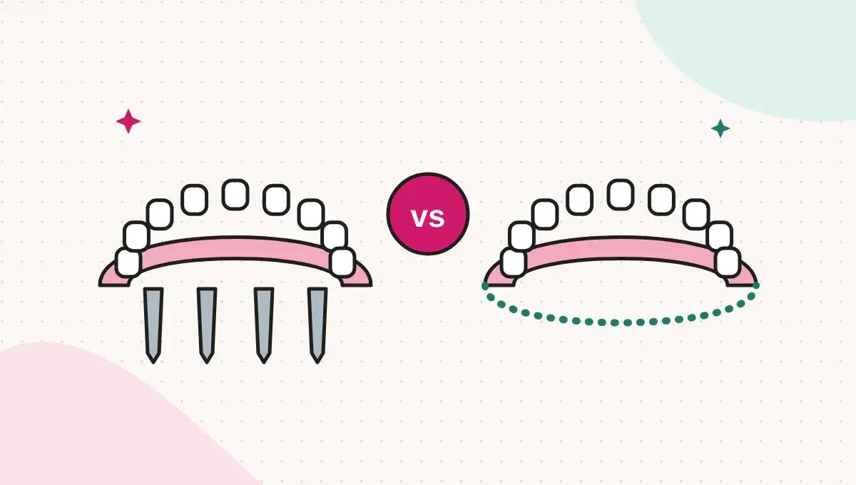 All-on-4 or Removable Dentures? What UK Patients Should Compare
